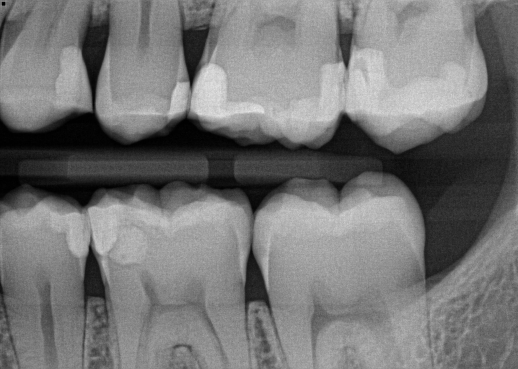 Everything You Need to Know About Extraoral Bitewings Renew Digital, LLC